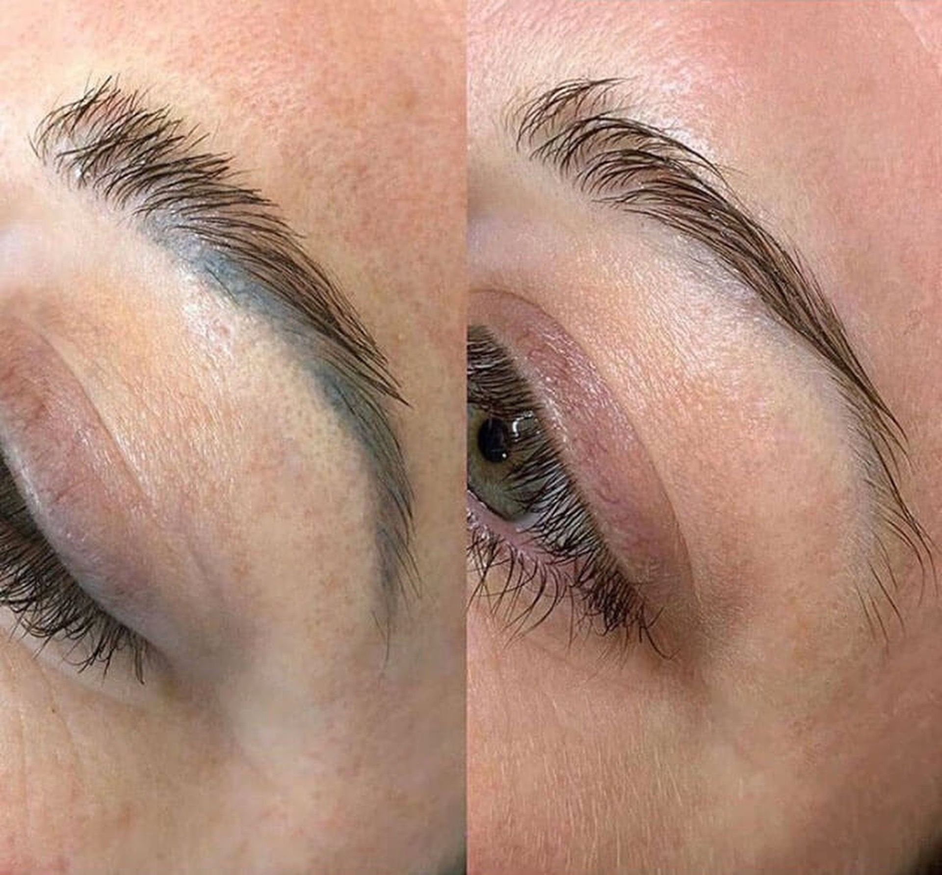 Tattoo Removal service at MK Permanent Makeup