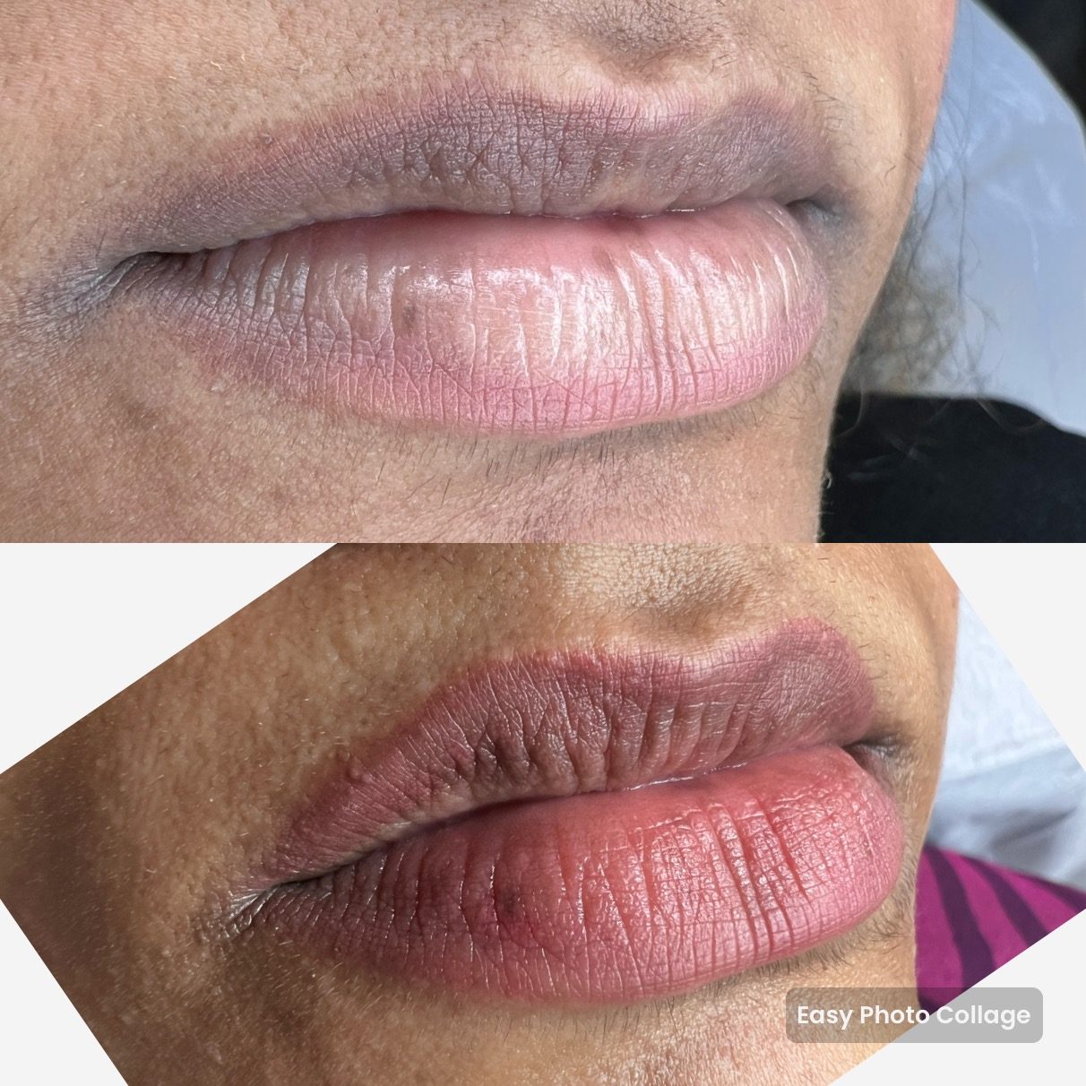 Lip neutralization — before and after