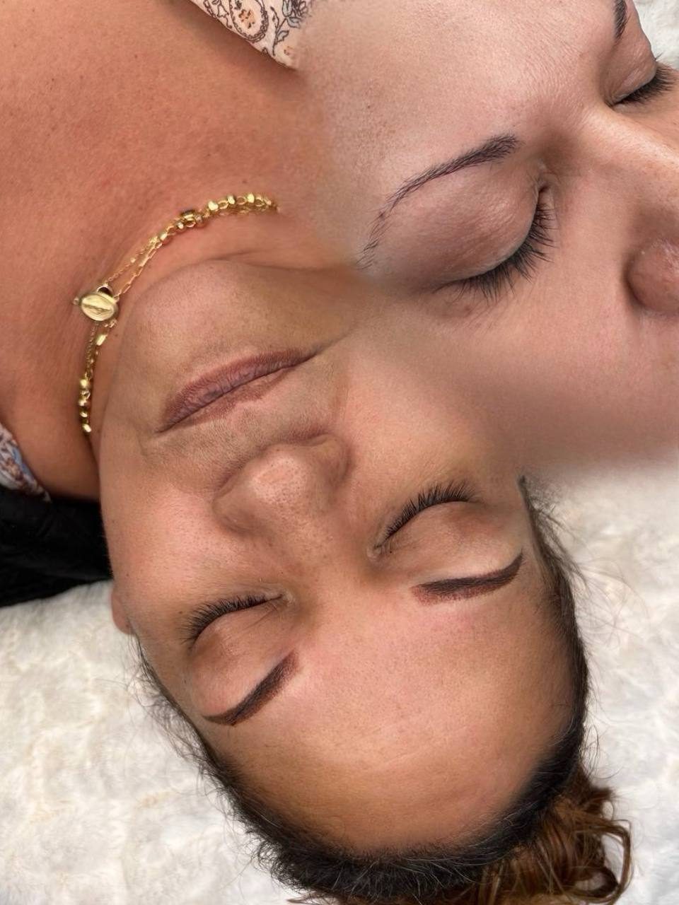 Brow results — before and after