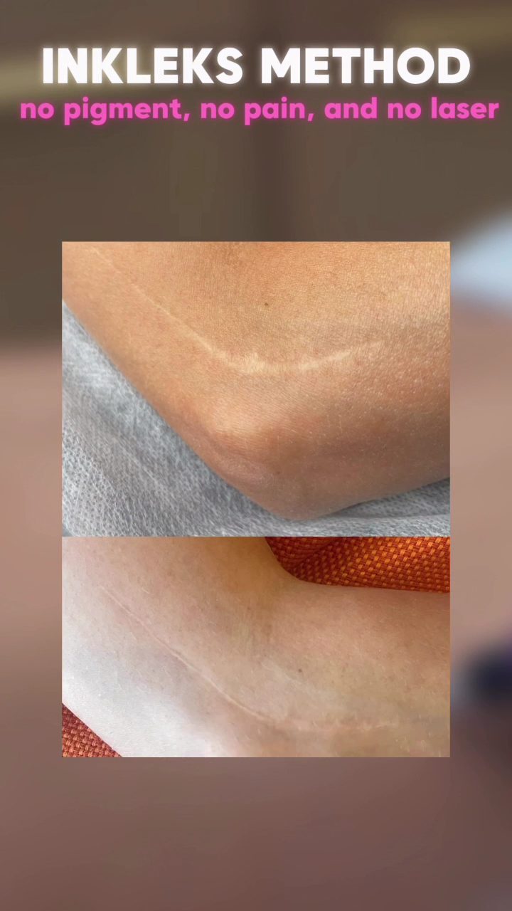Inkless-method removal at MK Permanent Makeup