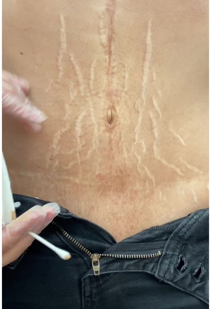 Stretch mark treatment at MK Permanent Makeup